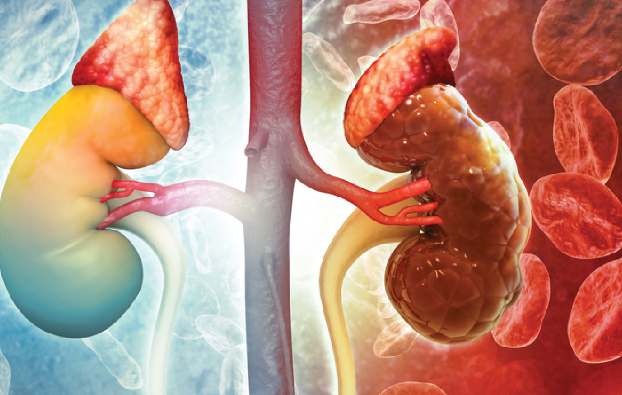 Suy thận có thể tấn công bất ngờ không báo trước: Đây là 4 đối tượng cần đặc biệt cảnh giác